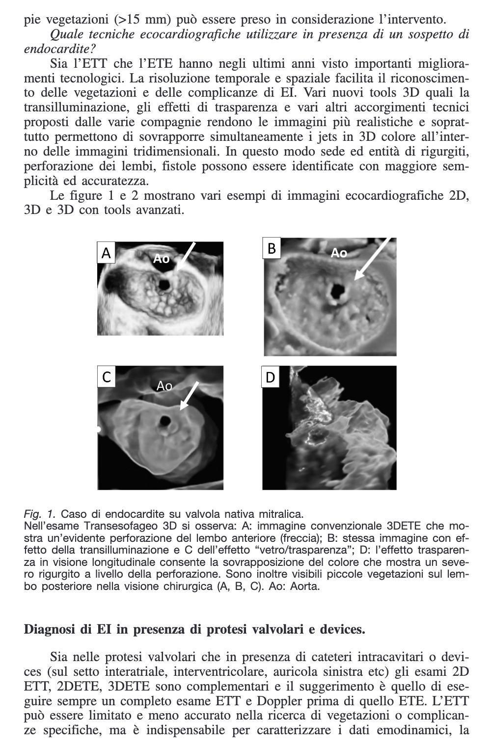 51 - Mauro Pepi - Challenges in cardiologia: diagnosi di endocardite su valvola nativa e protesica
