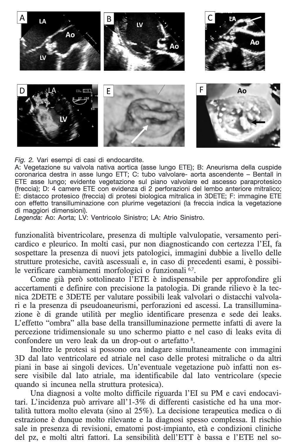 51 - Mauro Pepi - Challenges in cardiologia: diagnosi di endocardite su valvola nativa e protesica