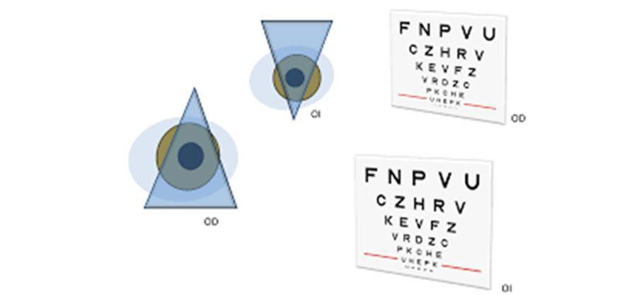 Balance y ecualización de la refracción (SUBJETIVO BINOCULAR DE LEJOS) Balance y ecualización de la refracción (SUBJETIVO BINOCULAR DE LEJOS)