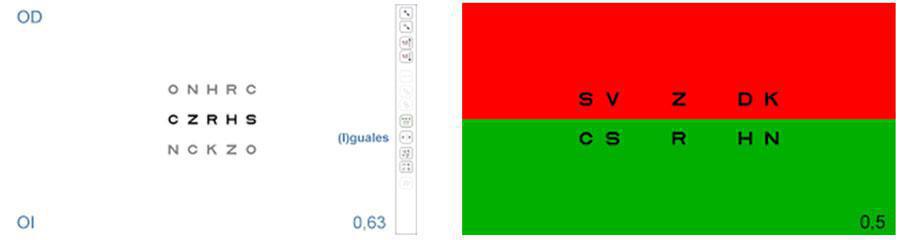 Balance y ecualización de la refracción (SUBJETIVO BINOCULAR DE LEJOS) Balance y ecualización de la refracción (SUBJETIVO BINOCULAR DE LEJOS)