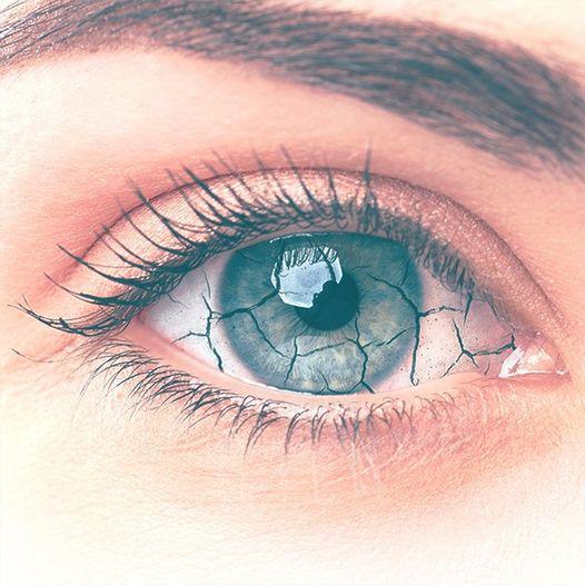 SINDROME DELL'OCCHIO SECCO SINDROME DELL'OCCHIO SECCO