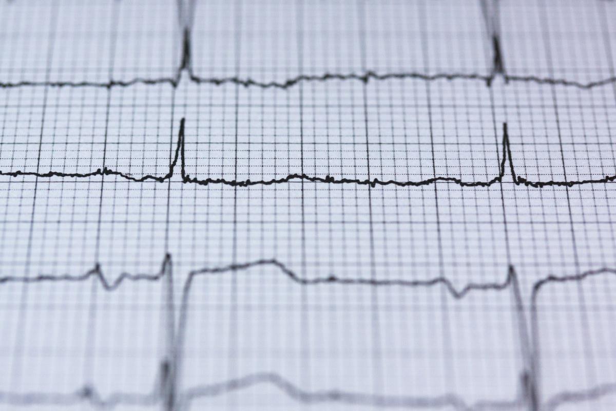 ECG - Elettrocardiogramma ECG - Elettrocardiogramma