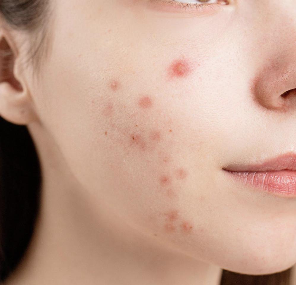 Acné