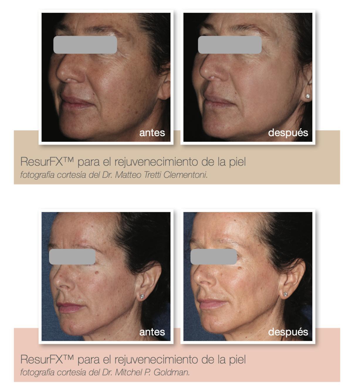 Resurf Fx - Láser fraccional no ablativo