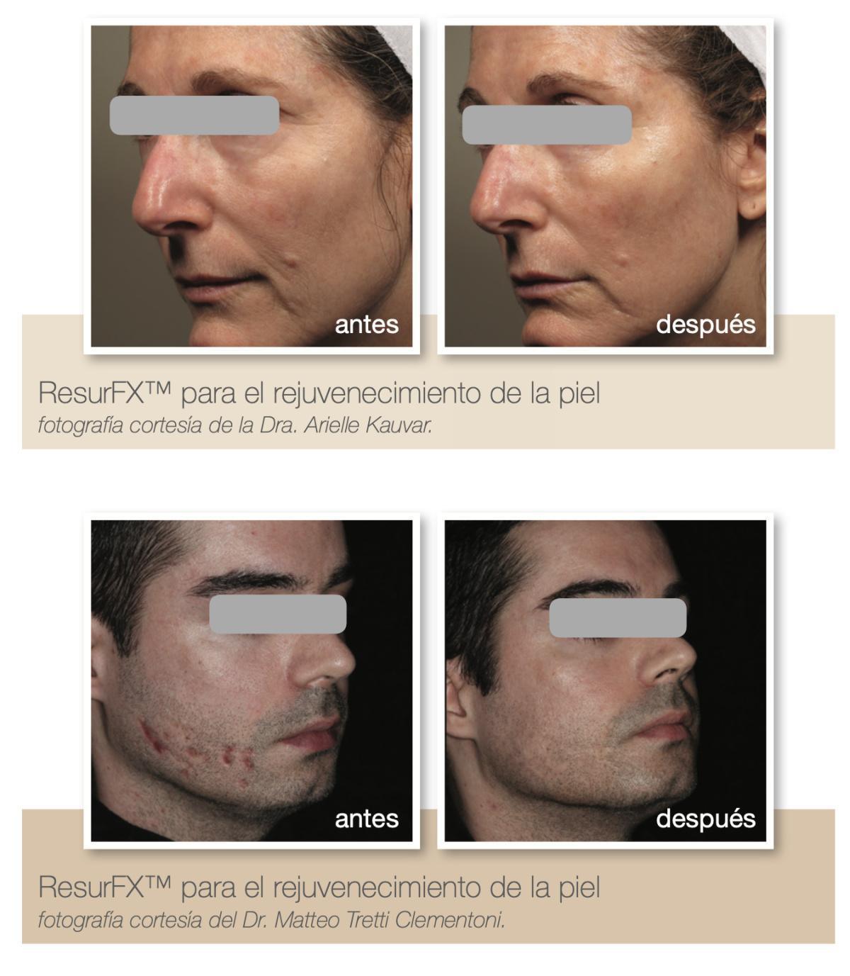 Resurf Fx - Láser fraccional no ablativo