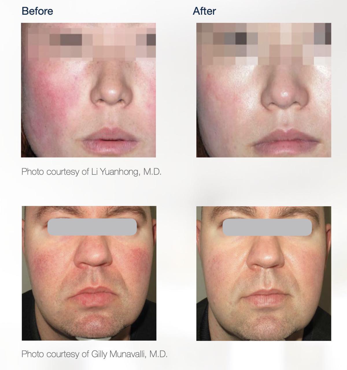 Stellar M22 - Láser IPL