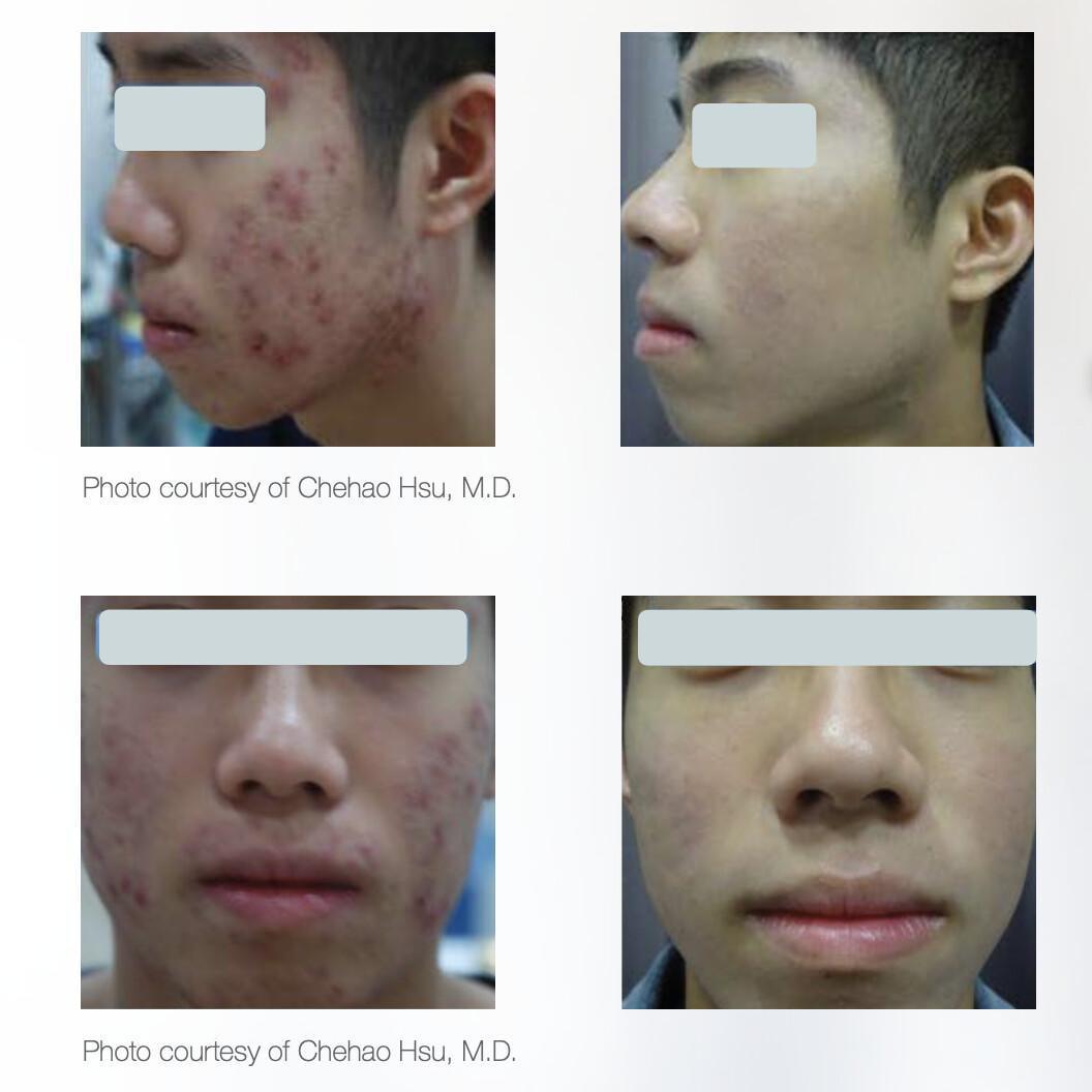 Stellar M22 - Láser IPL