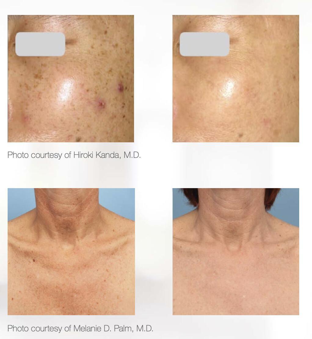 Stellar M22 - Láser IPL