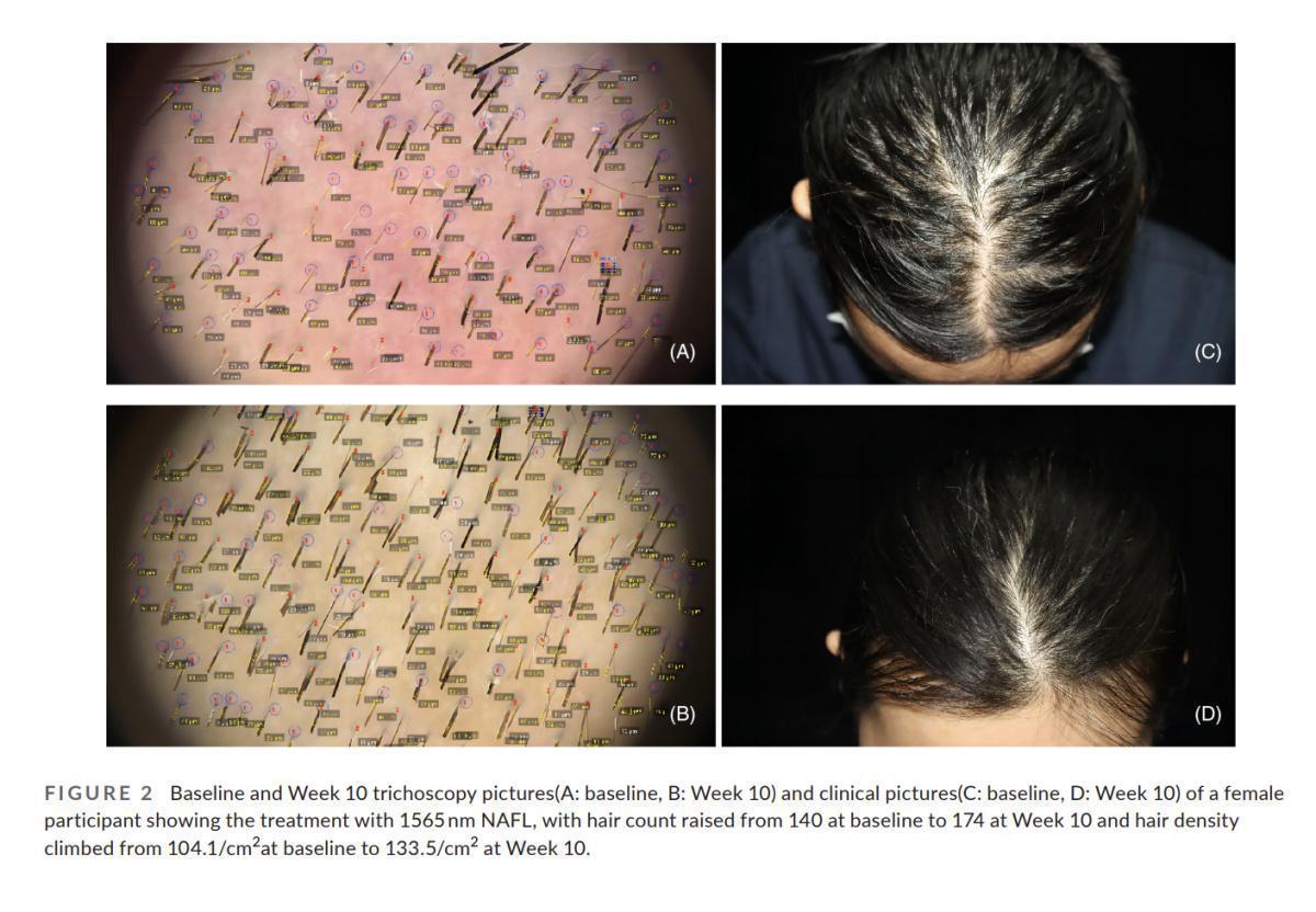 Resur Hair - Láser capilar avanzado