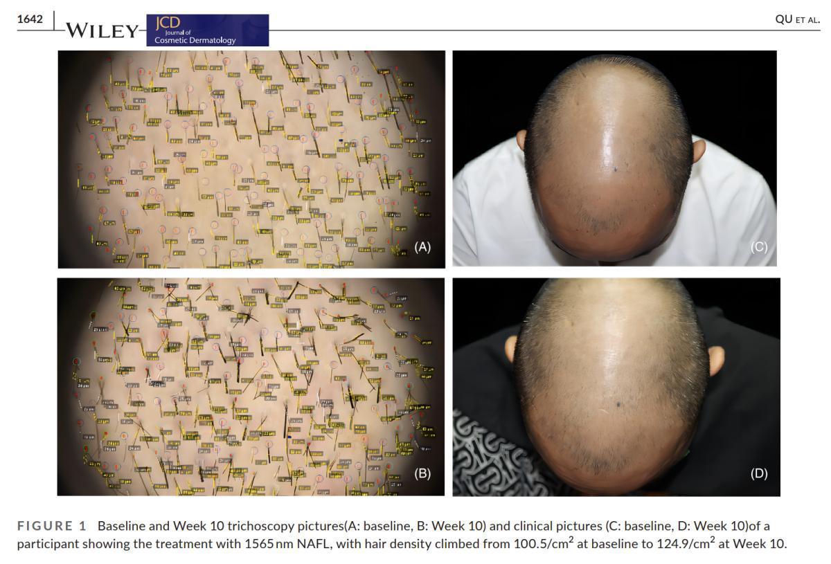 Resur Hair - Láser capilar avanzado