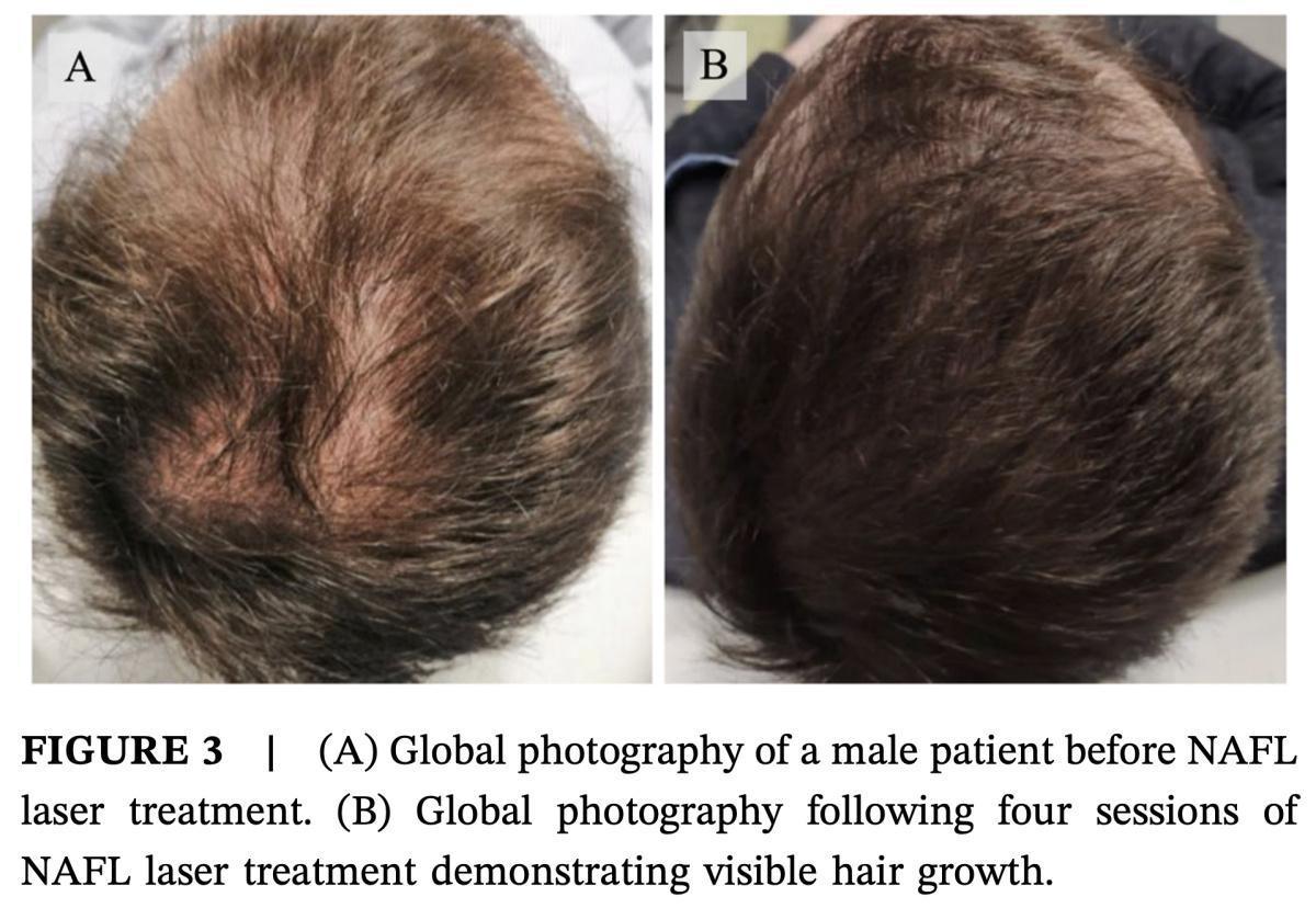 Resur Hair - Láser capilar avanzado