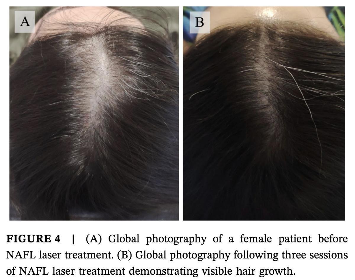 Resur Hair - Láser capilar avanzado