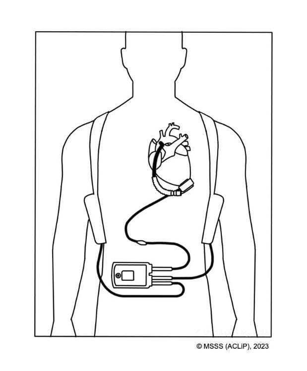 02. Arrêt cardiorespiratoire avec DAVG 02. Arrêt cardiorespiratoire avec DAVG