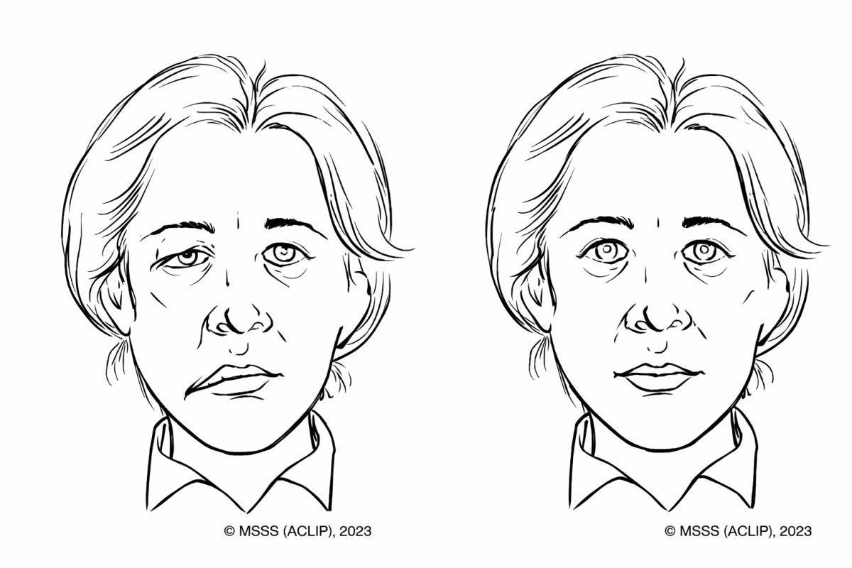 11. Appréciation spécifique : échelle de dépistage de l’AVC – Cincinnati