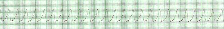 14. Appréciation spécifique : rythmes en arrêt cardiorespiratoire