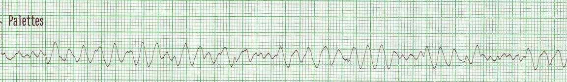 14. Appréciation spécifique : rythmes en arrêt cardiorespiratoire