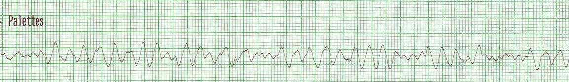 14. Appréciation spécifique : rythmes en arrêt cardiorespiratoire 14. Appréciation spécifique : rythmes en arrêt cardiorespiratoire