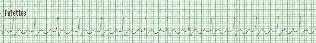14. Appréciation spécifique : rythmes en arrêt cardiorespiratoire 14. Appréciation spécifique : rythmes en arrêt cardiorespiratoire