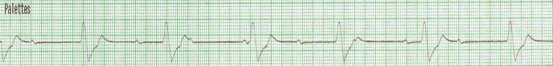 14. Appréciation spécifique : rythmes en arrêt cardiorespiratoire
