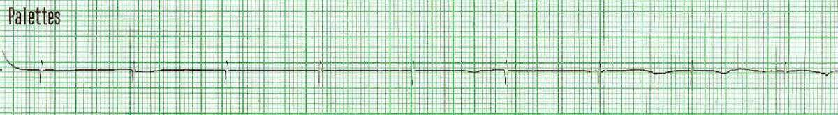 14. Appréciation spécifique : rythmes en arrêt cardiorespiratoire