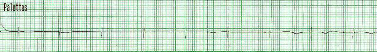 14. Appréciation spécifique : rythmes en arrêt cardiorespiratoire 14. Appréciation spécifique : rythmes en arrêt cardiorespiratoire