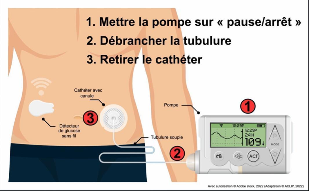 09. Hypoglycémie
