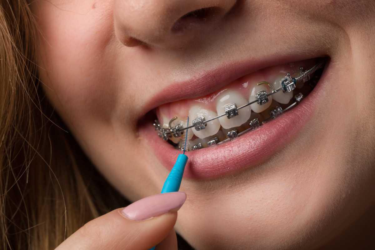 Zahnspange, Aligner & die Sache mit der Zusatzversicherung Zahnspange, Aligner & die Sache mit der Zusatzversicherung