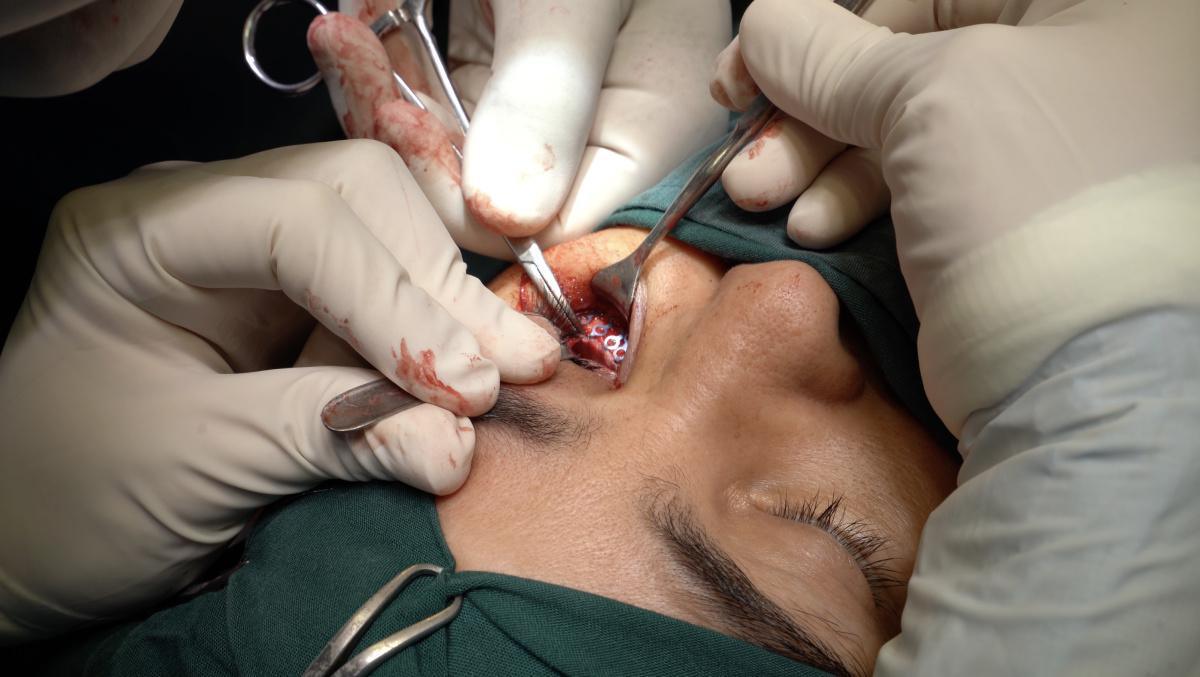 Tratamiento de paciente con fractura de la pared medial de la órbita Tratamiento de paciente con fractura de la pared medial de la órbita