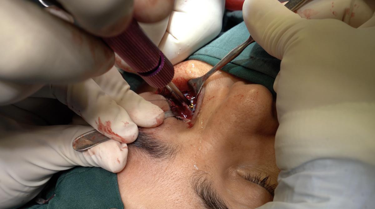Tratamiento de paciente con fractura de la pared medial de la órbita Tratamiento de paciente con fractura de la pared medial de la órbita