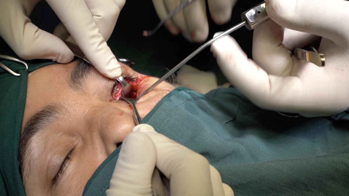 Tratamiento de paciente con fractura de la pared medial de la órbita Tratamiento de paciente con fractura de la pared medial de la órbita