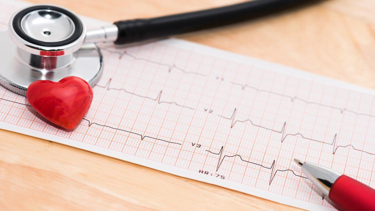 ECG - Elettrocardiogramma