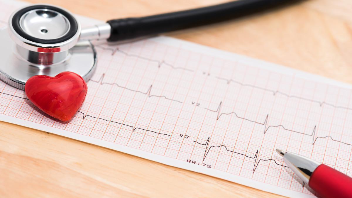ECG - Elettrocardiogramma ECG - Elettrocardiogramma