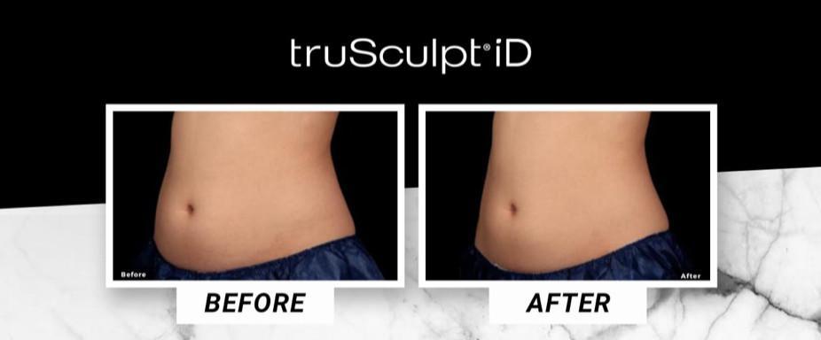 Introducing truSculpt iD