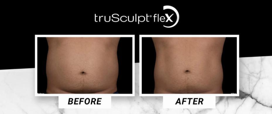 Have You Tried truSculpt fleX?