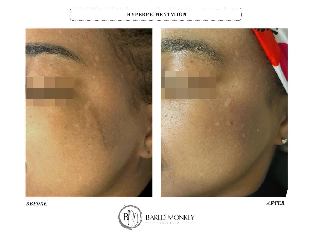 HYPERPIGMENTATION