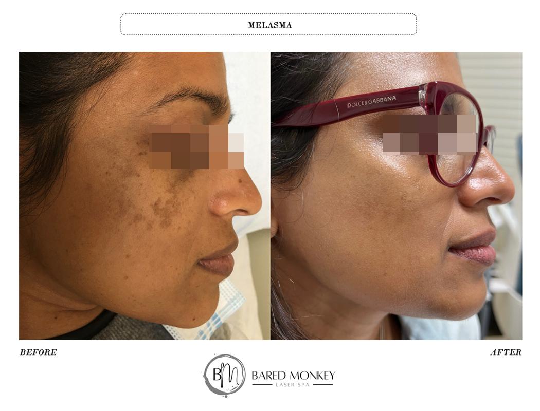 MELASMA