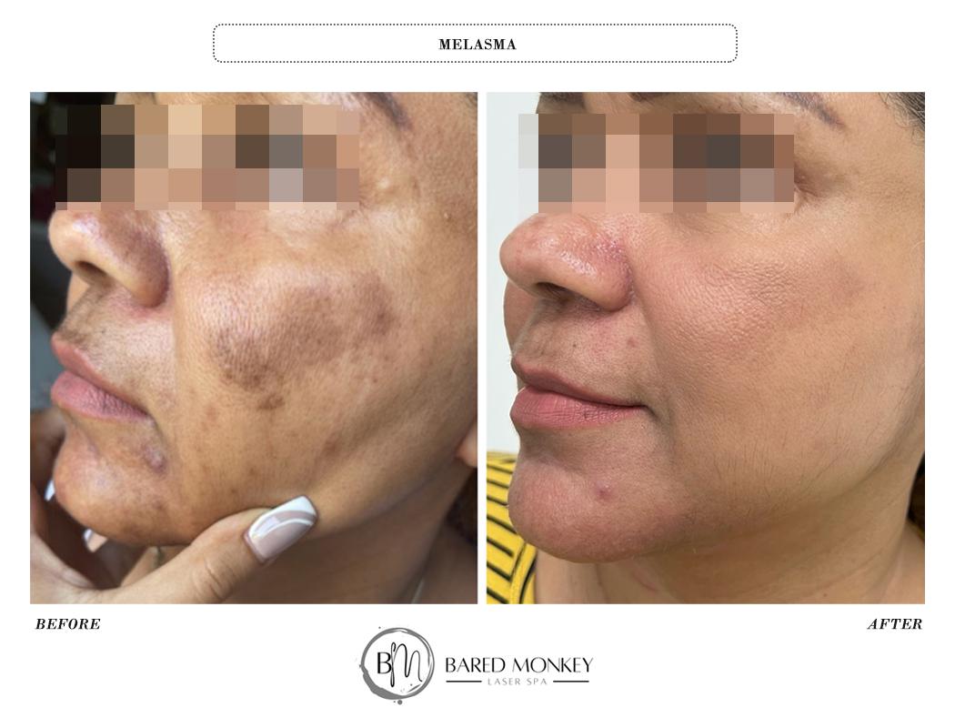 MELASMA