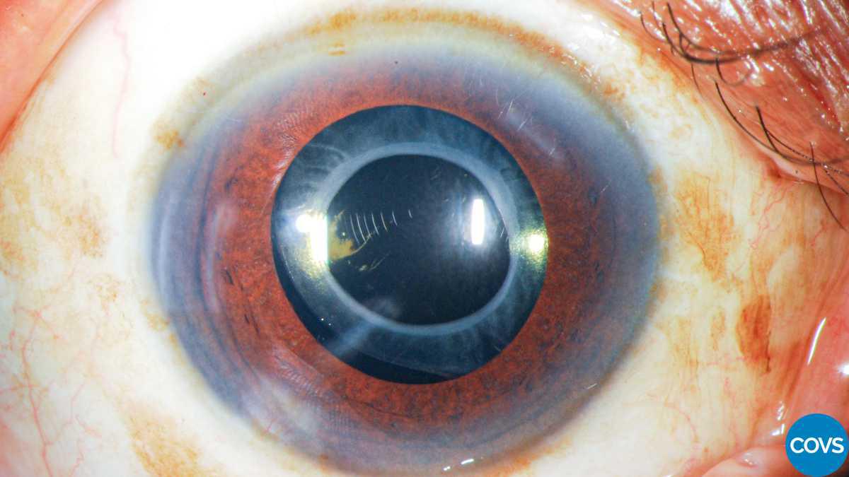 Contracción de la cápsula anterior asociado a dolor ocular bilateral con lentes intraoculares hidrofóbicos