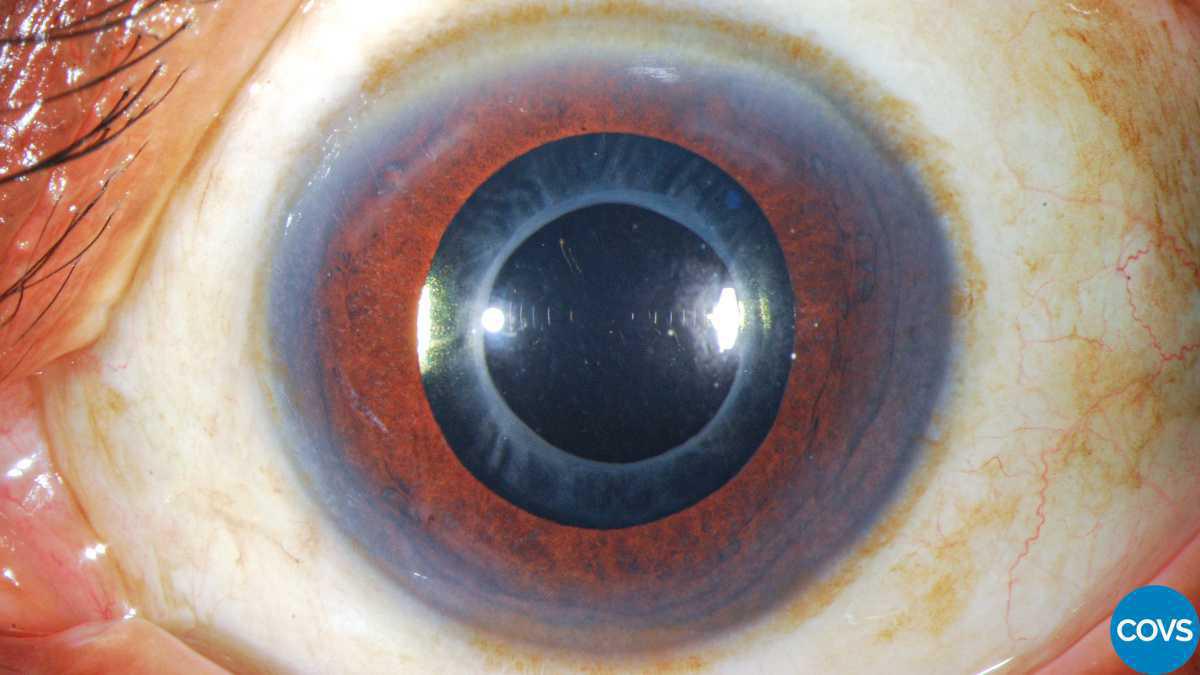 Contracción de la cápsula anterior asociado a dolor ocular bilateral con lentes intraoculares hidrofóbicos Contracción de la cápsula anterior asociado a dolor ocular bilateral con lentes intraoculares hidrofóbicos
