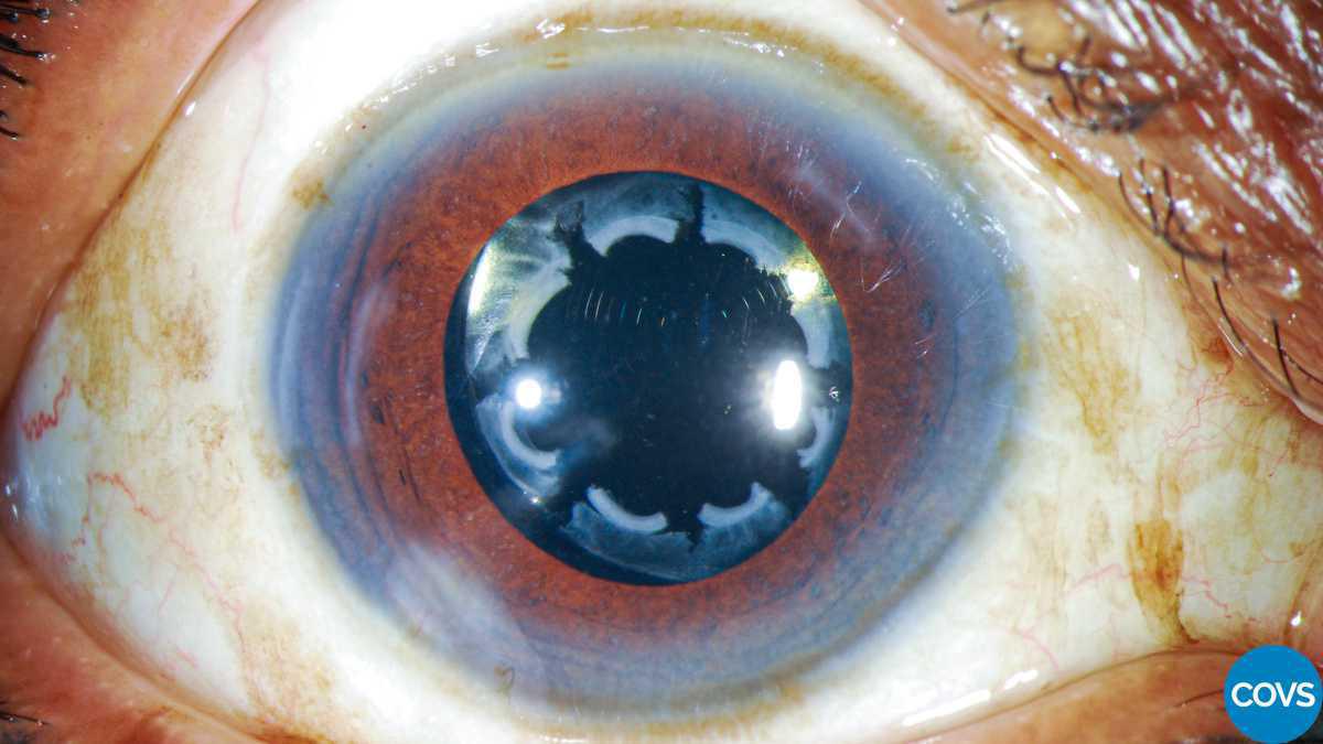 Contracción de la cápsula anterior asociado a dolor ocular bilateral con lentes intraoculares hidrofóbicos Contracción de la cápsula anterior asociado a dolor ocular bilateral con lentes intraoculares hidrofóbicos