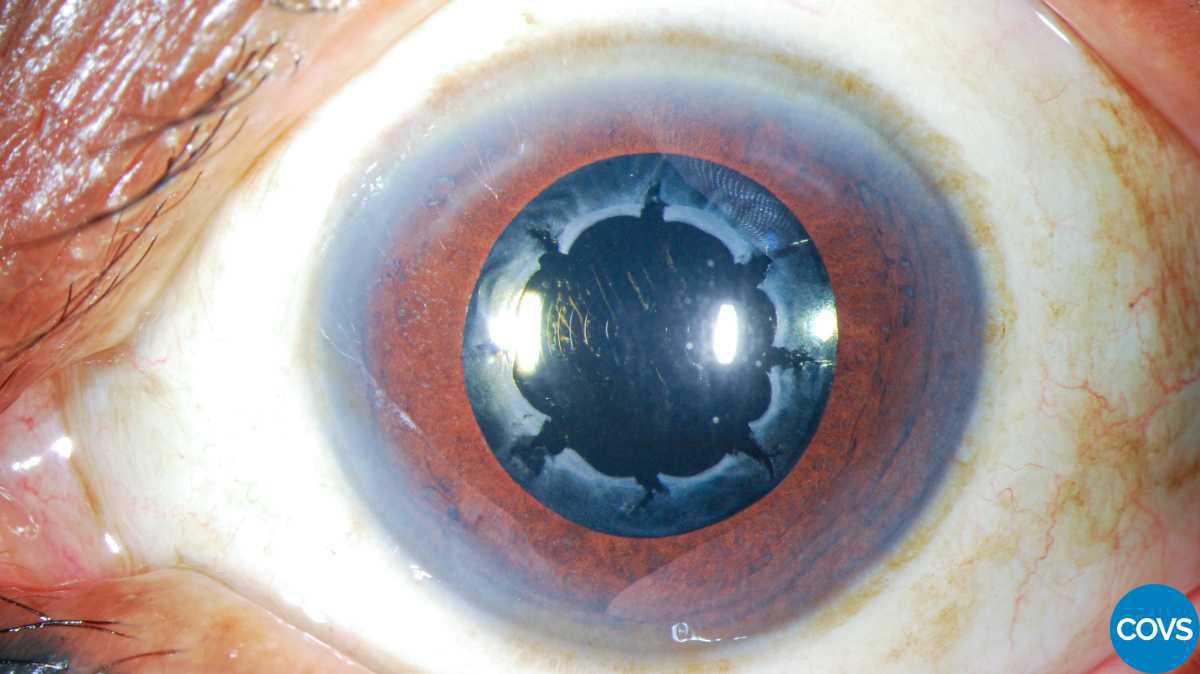 Contracción de la cápsula anterior asociado a dolor ocular bilateral con lentes intraoculares hidrofóbicos Contracción de la cápsula anterior asociado a dolor ocular bilateral con lentes intraoculares hidrofóbicos