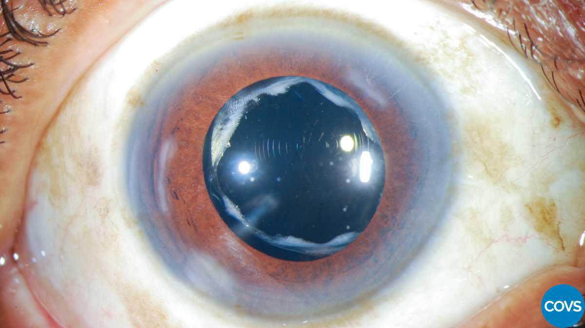 Contracción de la cápsula anterior asociado a dolor ocular bilateral con lentes intraoculares hidrofóbicos