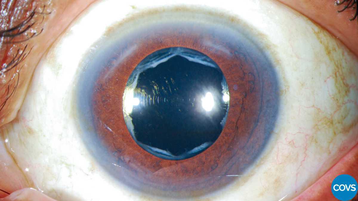 Contracción de la cápsula anterior asociado a dolor ocular bilateral con lentes intraoculares hidrofóbicos