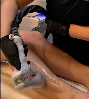 EPILAZIONE LASER EPILAZIONE LASER