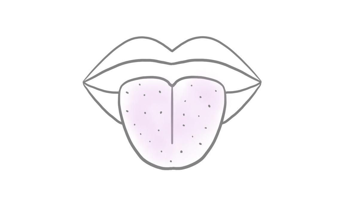 2.9.4 Streptokokken-Angina und Scharlach 2.9.4 Streptokokken-Angina und Scharlach