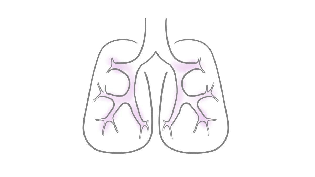 2.9.1.5 Obstruktive Bronchitis/Asthma bronchiale 2.9.1.5 Obstruktive Bronchitis/Asthma bronchiale