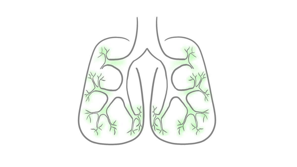 2.9.1.6 Bronchiolitis