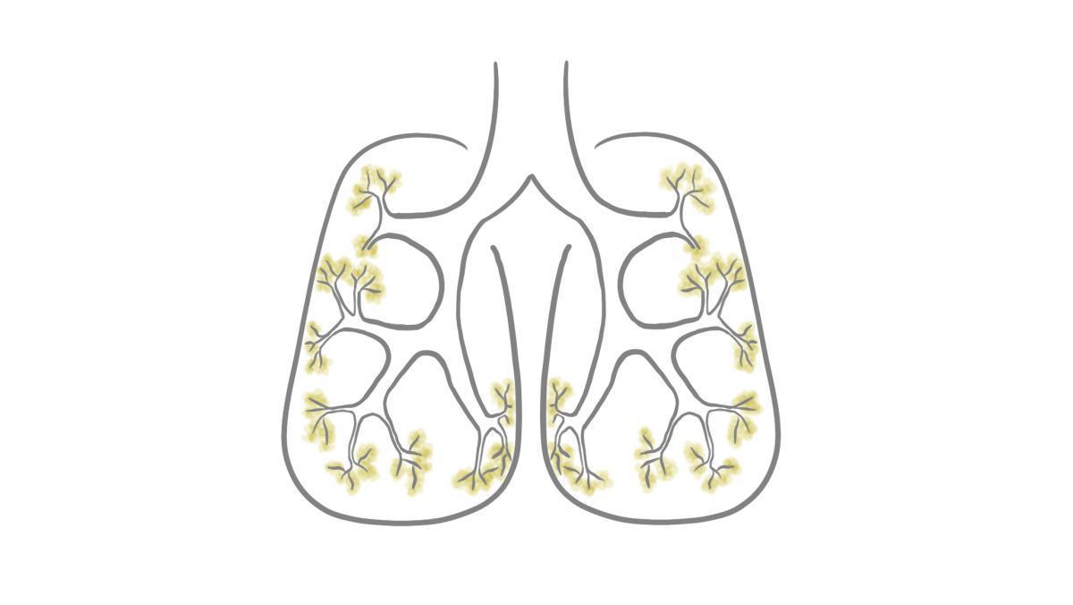 2.9.1.7 Pneumonie (Lungenentzündung) 2.9.1.7 Pneumonie (Lungenentzündung)