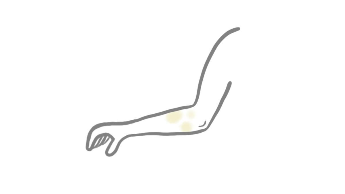 2.9.8 Borkenflechte (Impetigo contagiosa)