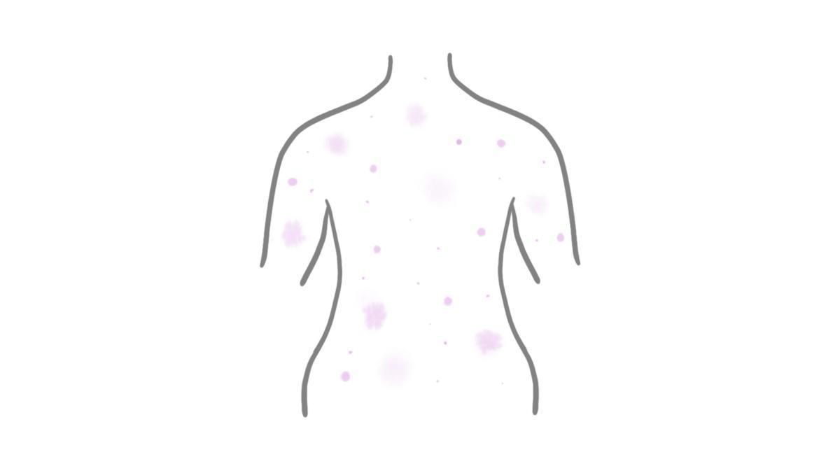 2.9.9 Windpocken 2.9.9 Windpocken